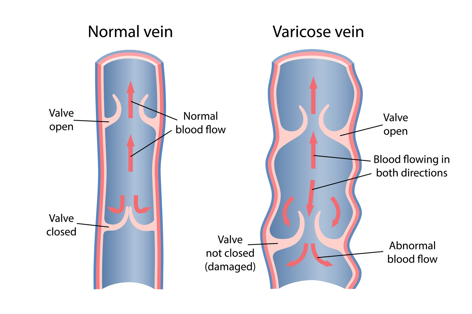 Diagram showing normal valve function vs valve reflux in Varicose veins